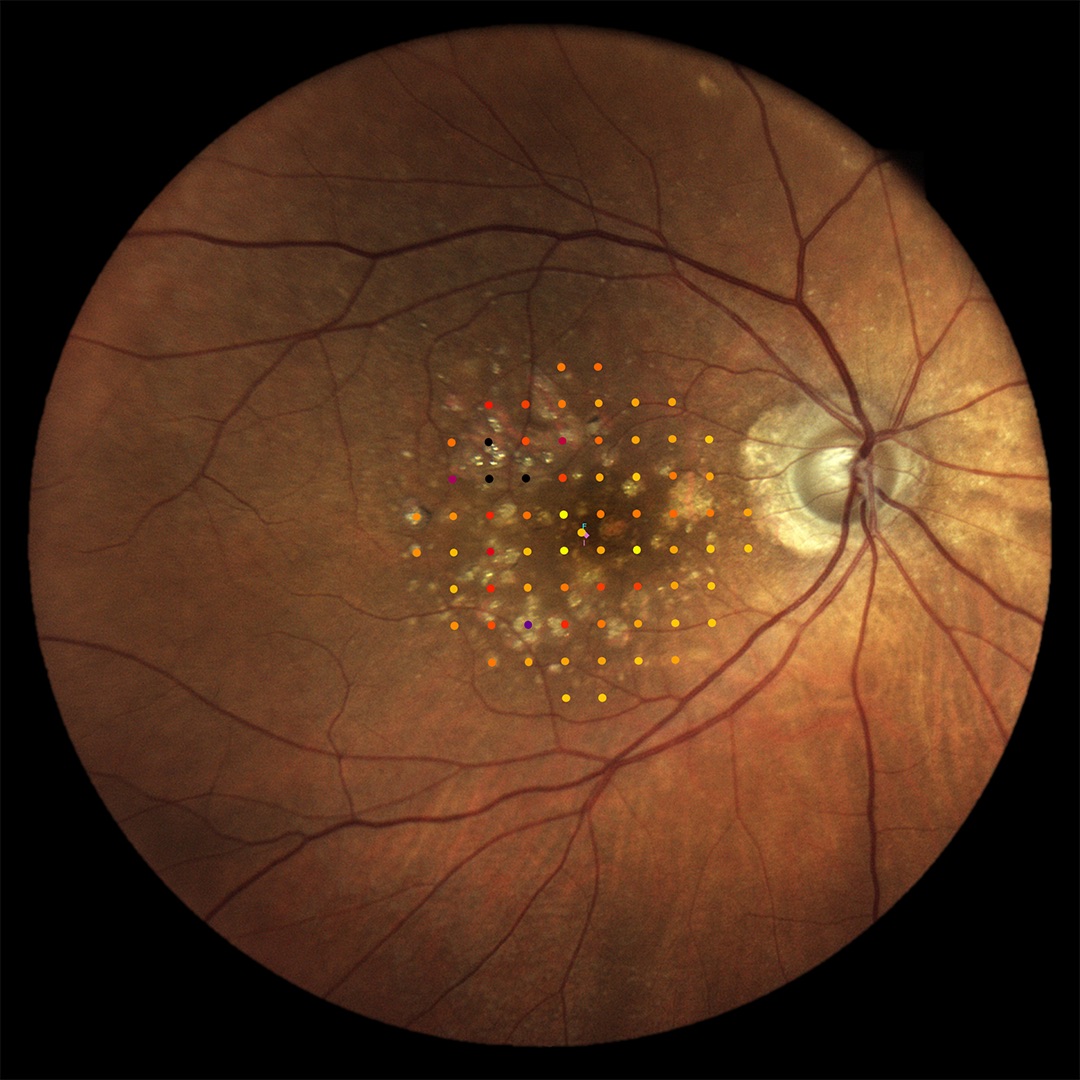 iCare MAIA TrueColor microperimetry grid overlay showing retinal sensitivity