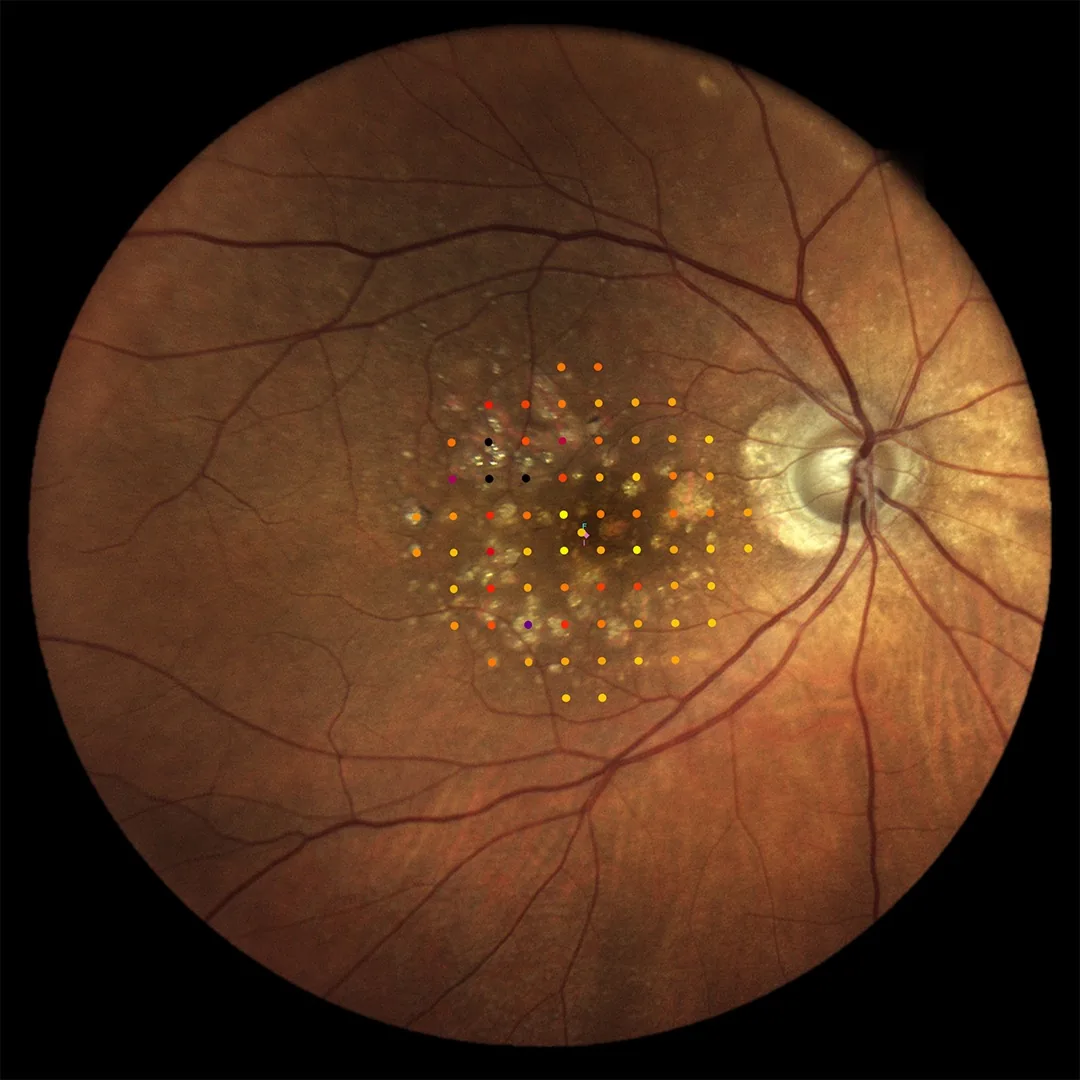 iCare MAIA TrueColor microperimetry grid overlay showing retinal sensitivity