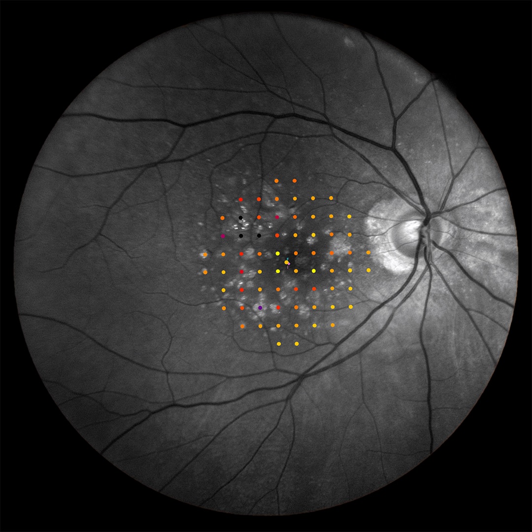 iCare MAIA red-free microperimetry grid showing vascular detail