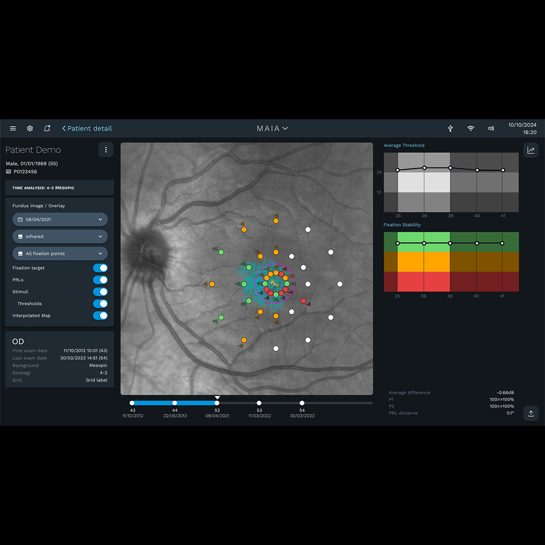 iCare MAIA time analysis showing mesopic sensitivity progression