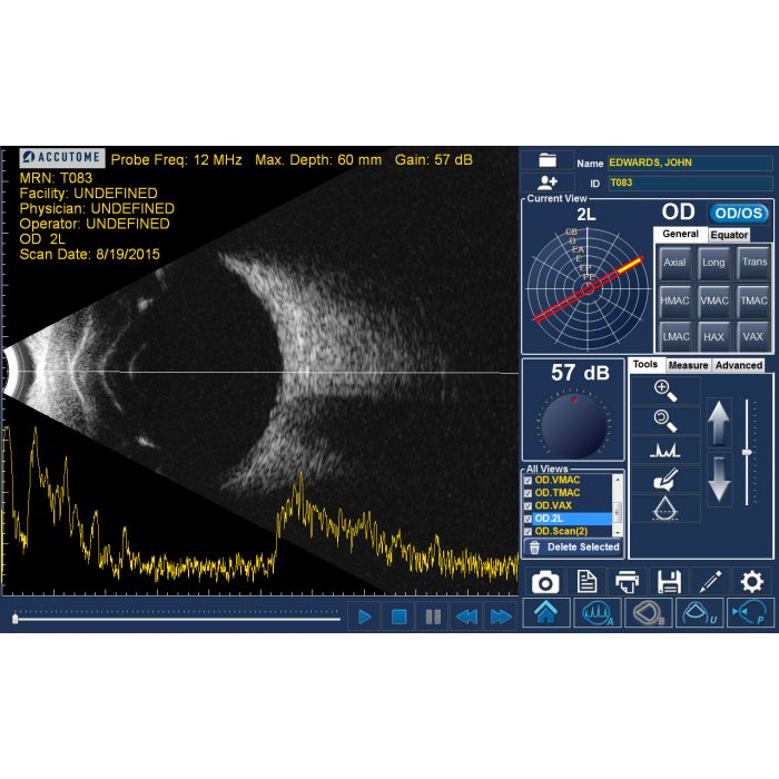 Keeler B-Scan posterior segment imaging
