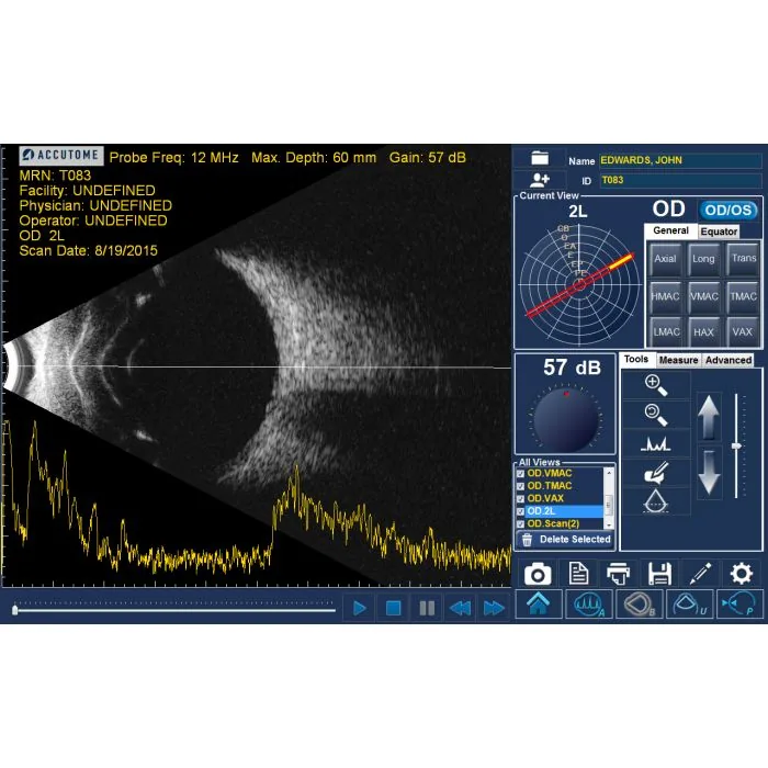Keeler B-Scan posterior segment imaging
