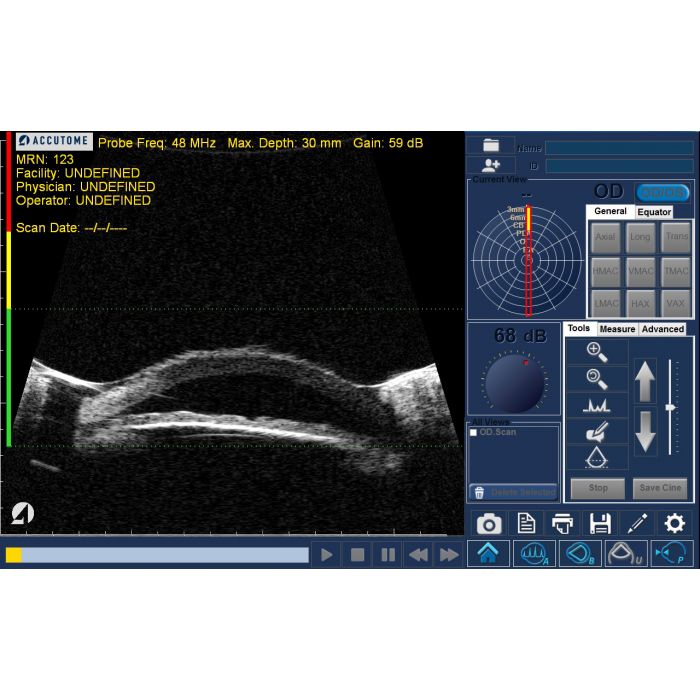 Keeler UBM high-resolution anterior segment imaging