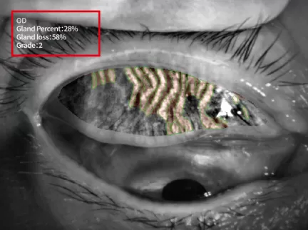 The Firefly S390L meibomian gland loss detail