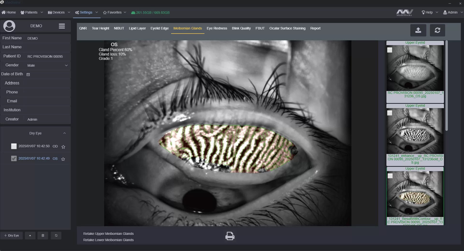 The Firefly S390L meibomian gland analysis interface