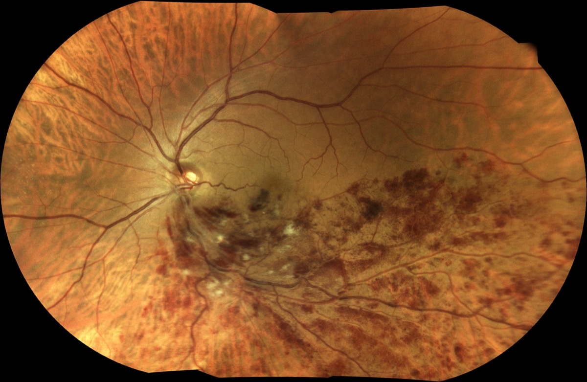 200-degree TrueColor mosaic showing branch retinal vein occlusion