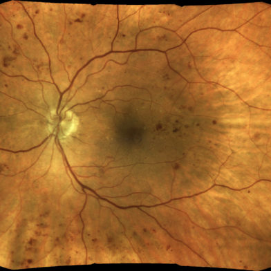 TrueColor confocal image of diabetic retinopathy