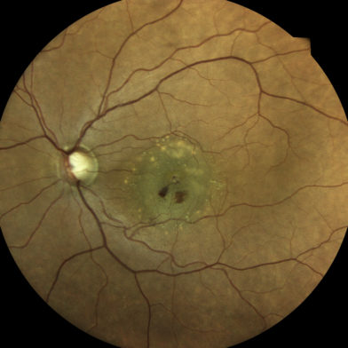 TrueColor confocal image of a pigment epithelium detachment due to AMD