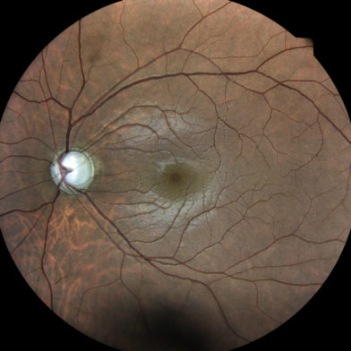 TrueColor confocal image of a glaucomatous optic nerve