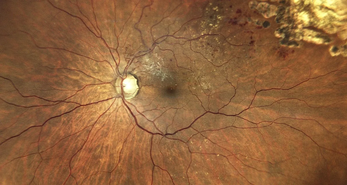 iCare EIDON Ultra-Widefield retinal imaging system