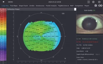 Corneal Topography