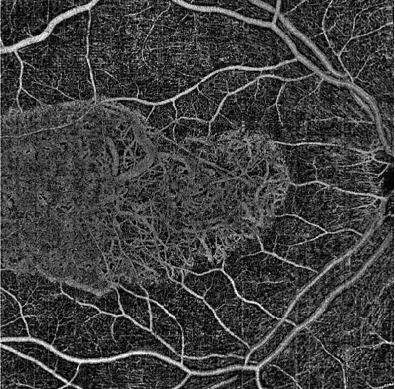 AngioVue OCT Angiography of the superficial retina, 9 x 9 mm scan captured on the Optovue Solix