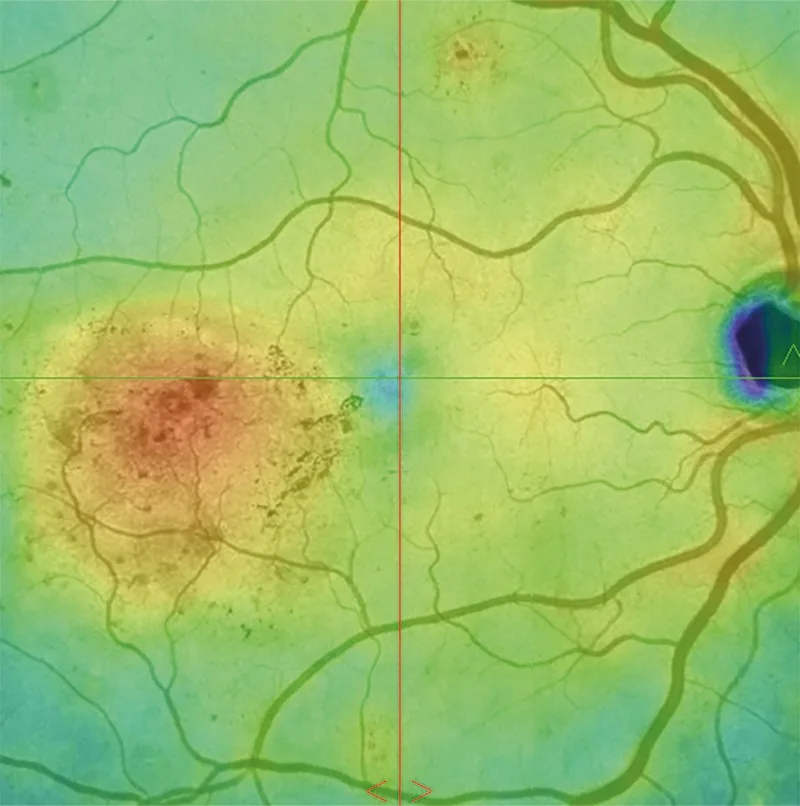 Retinal thickness map showing macular thickness measurements