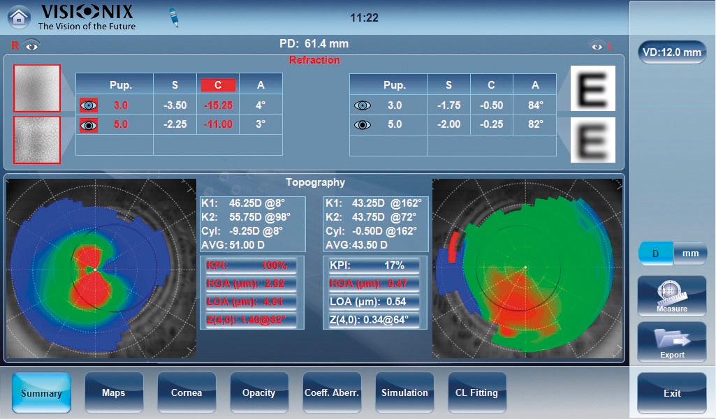 Visionix keratoconus screening topography maps with KPI analysis